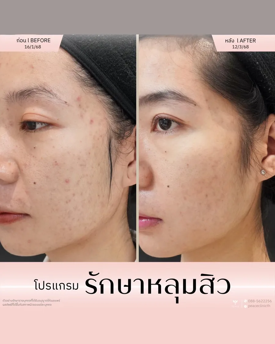 รักษาหลุมสิว — มุมเฉียง