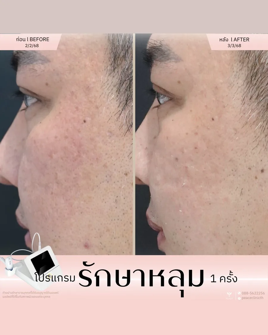 รักษาหลุมสิว — มุมด้านข้าง · หลังทำ 1 ครั้ง