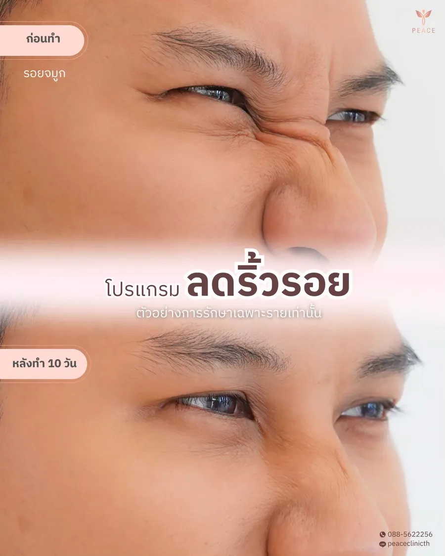 โบท็อกซ์ · ลดริ้วรอย — รอยย่นจมูก · หลังทำ 10 วัน