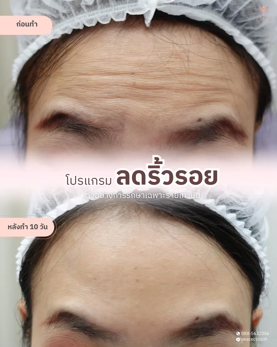 โบท็อกซ์ · ริ้วรอยหน้าผาก