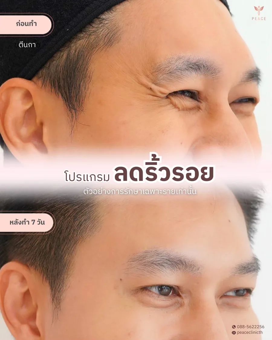 โบท็อกซ์ · ลดริ้วรอย — รอยตีนกา · หลังทำ 7 วัน