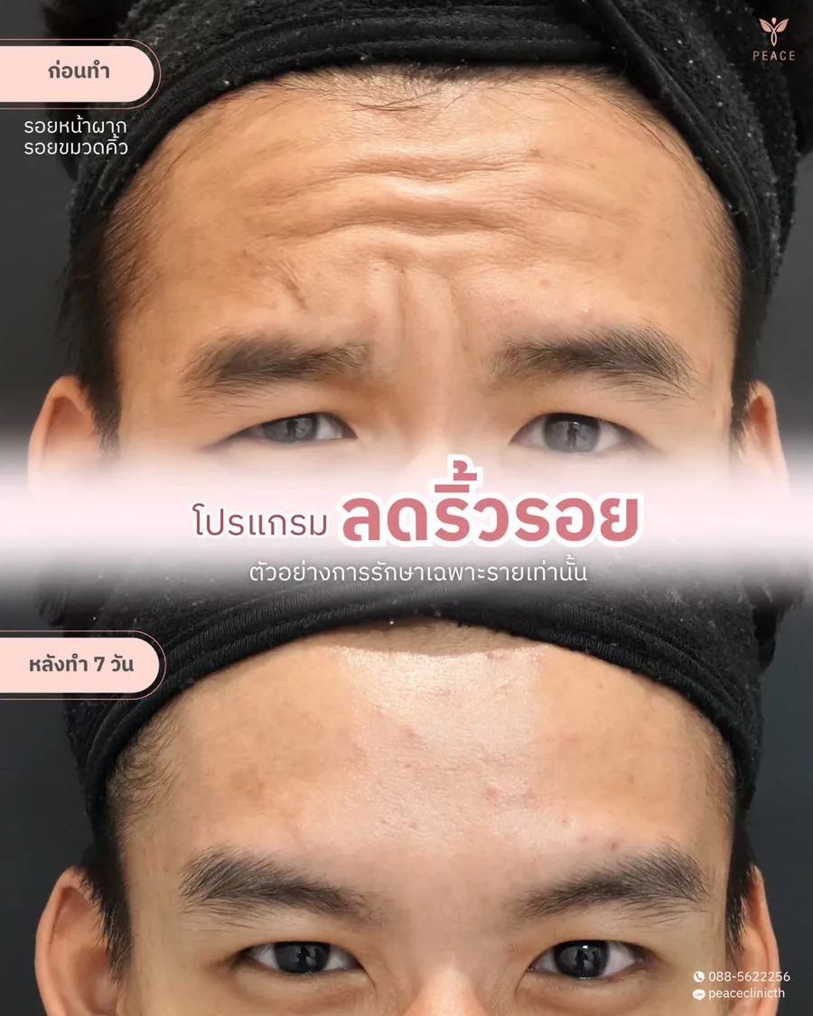โบท็อกซ์ · ลดริ้วรอย — หน้าผากและขมวดคิ้ว · หลังทำ 7 วัน