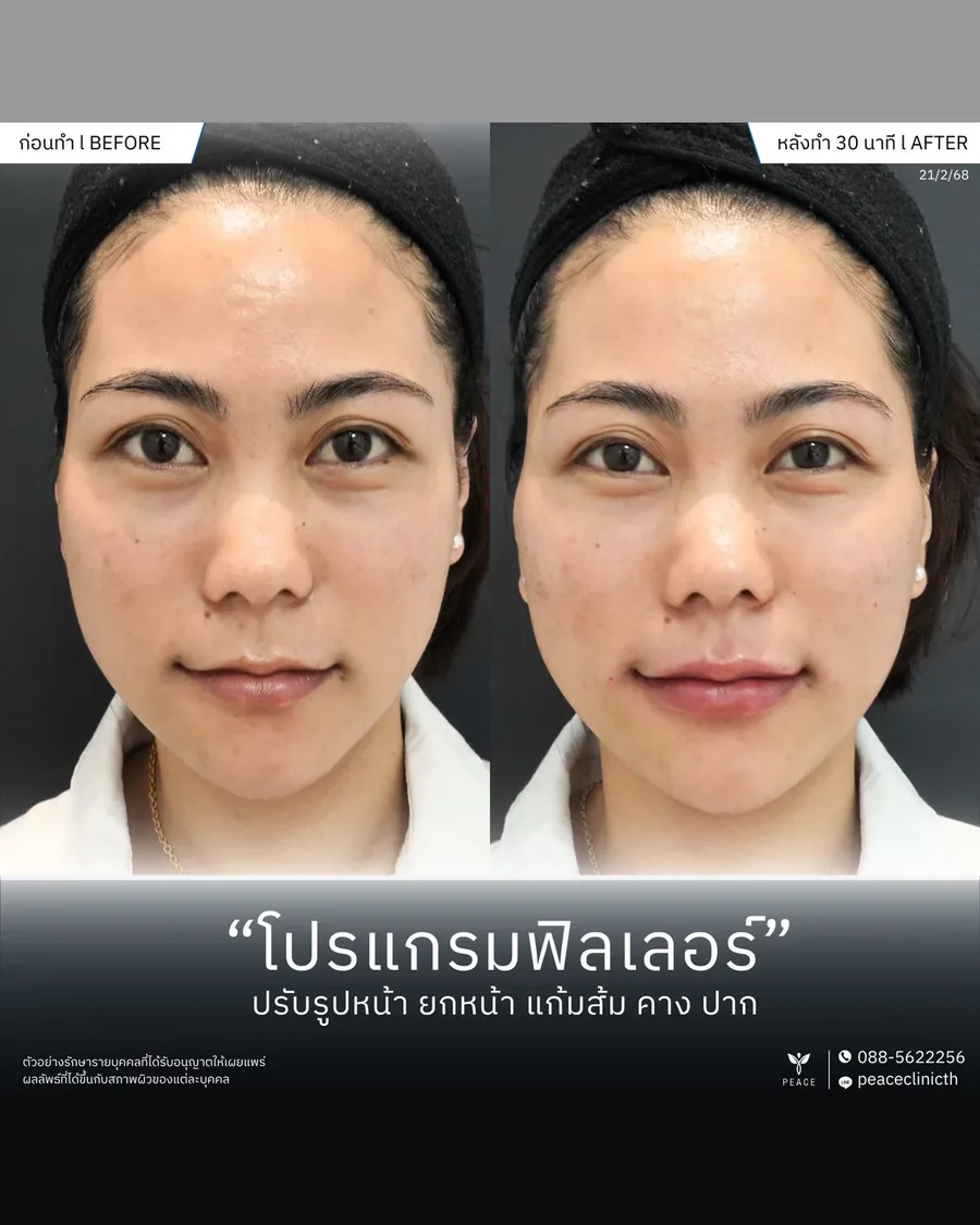 ฟิลเลอร์ · ปรับรูปหน้า — หน้าตรง