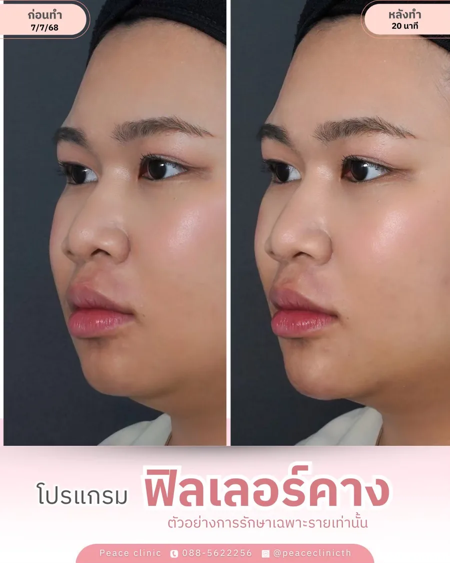 ฟิลเลอร์ · คาง — มุมด้านข้าง · หลังทำ 30 นาที