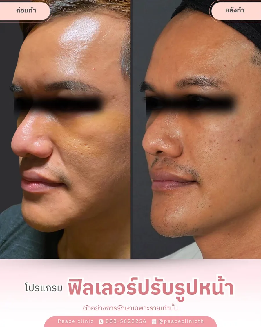 ฟิลเลอร์ · ปรับรูปหน้า มุมเฉียง