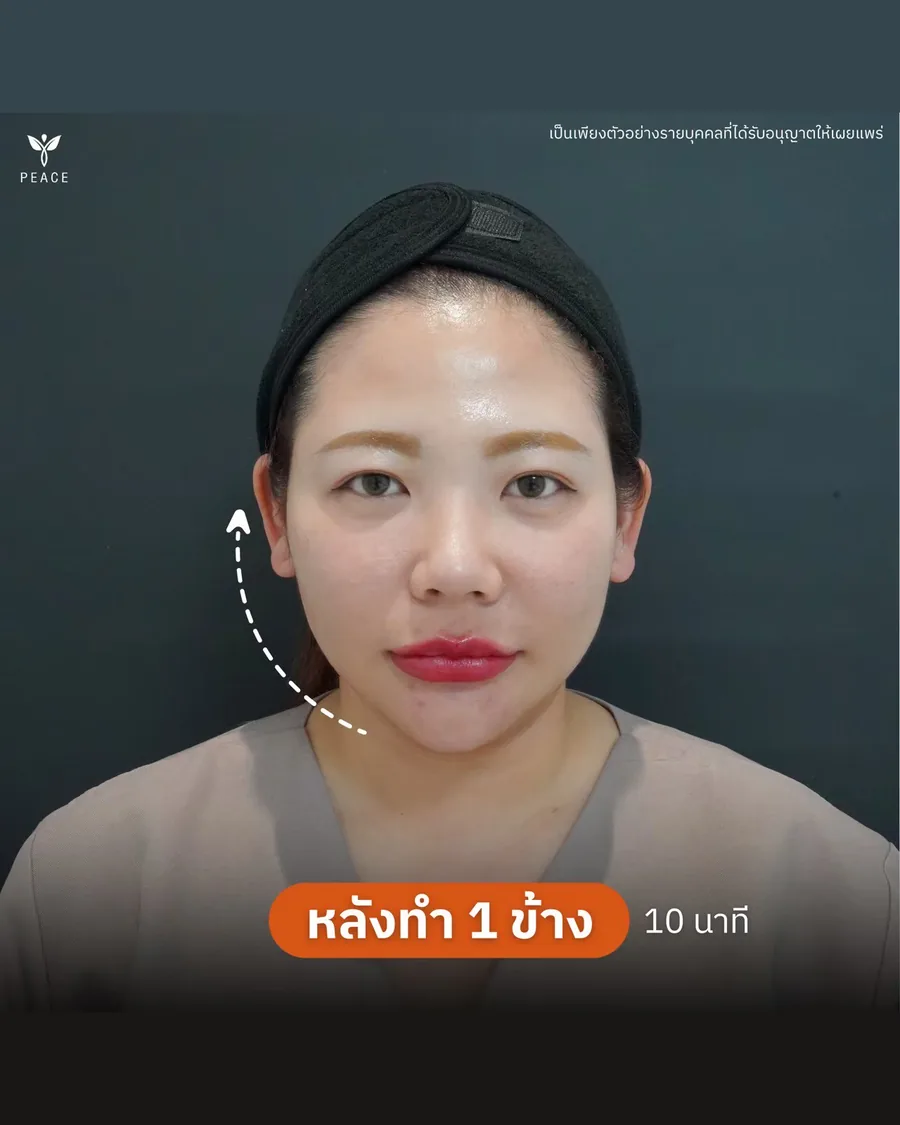 HArmonyCa · ยกกระชับ — หลังทำข้างเดียว 10 นาที