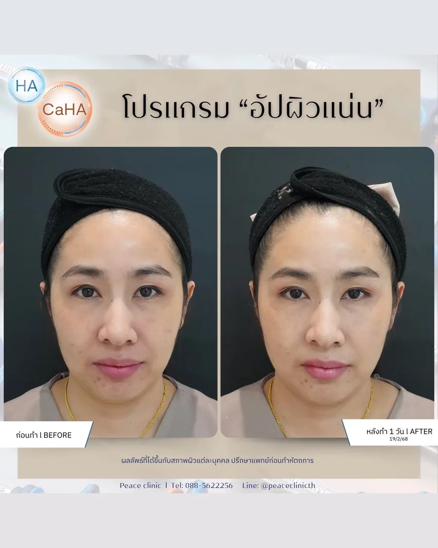 HArmonyCa · ยกกระชับ — หน้าตรง · หลังทำ 1.5 เดือน