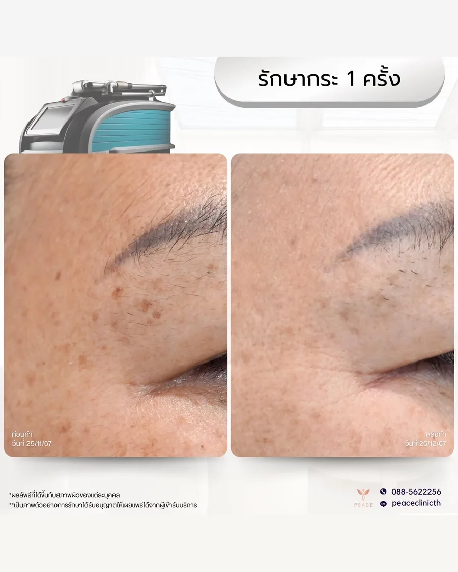 PicoSure · รักษากระ — รอบดวงตาและขมับ · หลังทำ 1 ครั้ง