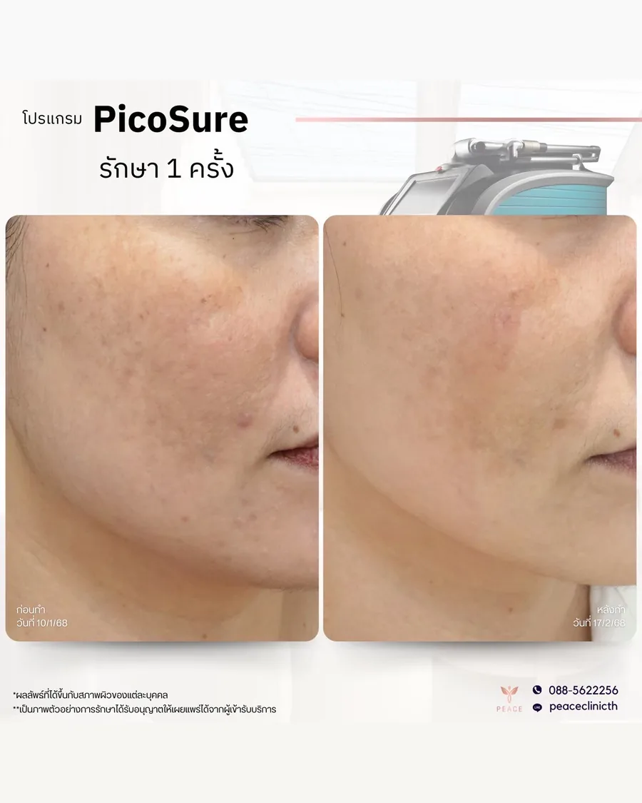 PicoSure · รักษากระ — แก้มและโหนกแก้ม · หลังทำ 1 ครั้ง