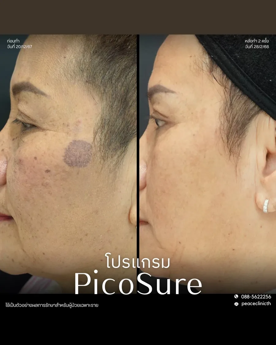 PicoSure · จุดด่างดำที่แก้ม