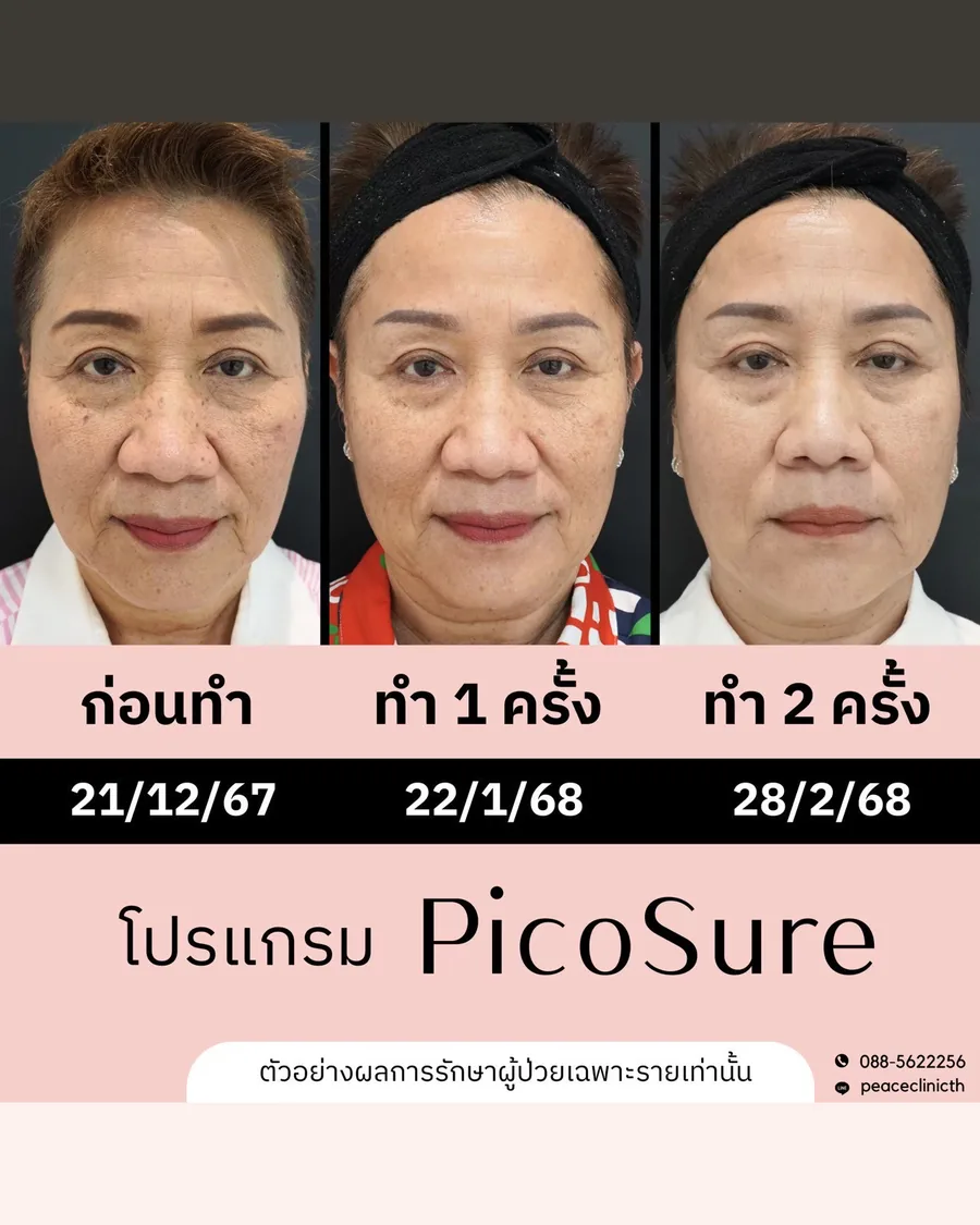 PicoSure · จุดด่างดำ — ก่อนทำ · หลัง 1 ครั้ง · หลัง 2 ครั้ง