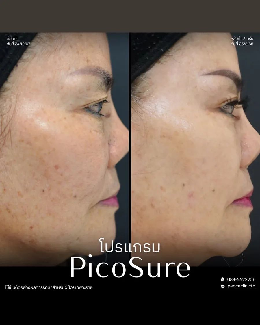 PicoSure · จุดด่างดำ — มุมด้านข้าง