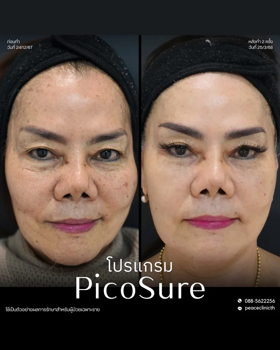 PicoSure · จุดด่างดำ