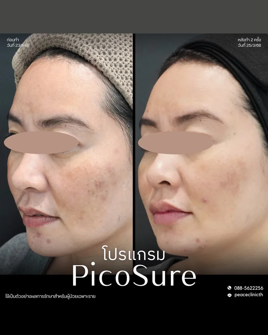 PicoSure · จุดด่างดำ — มุมเฉียง