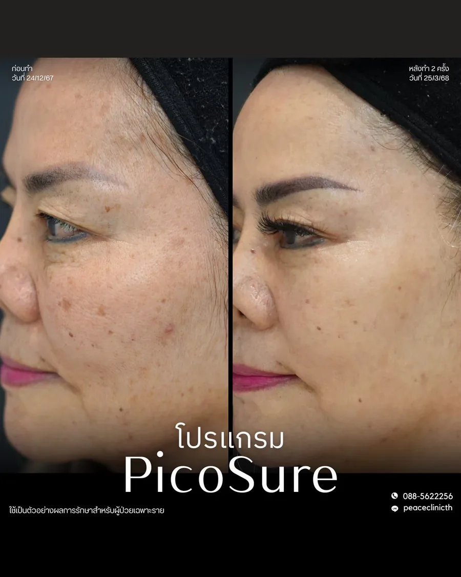 PicoSure · จุดด่างดำ — มุมเฉียง