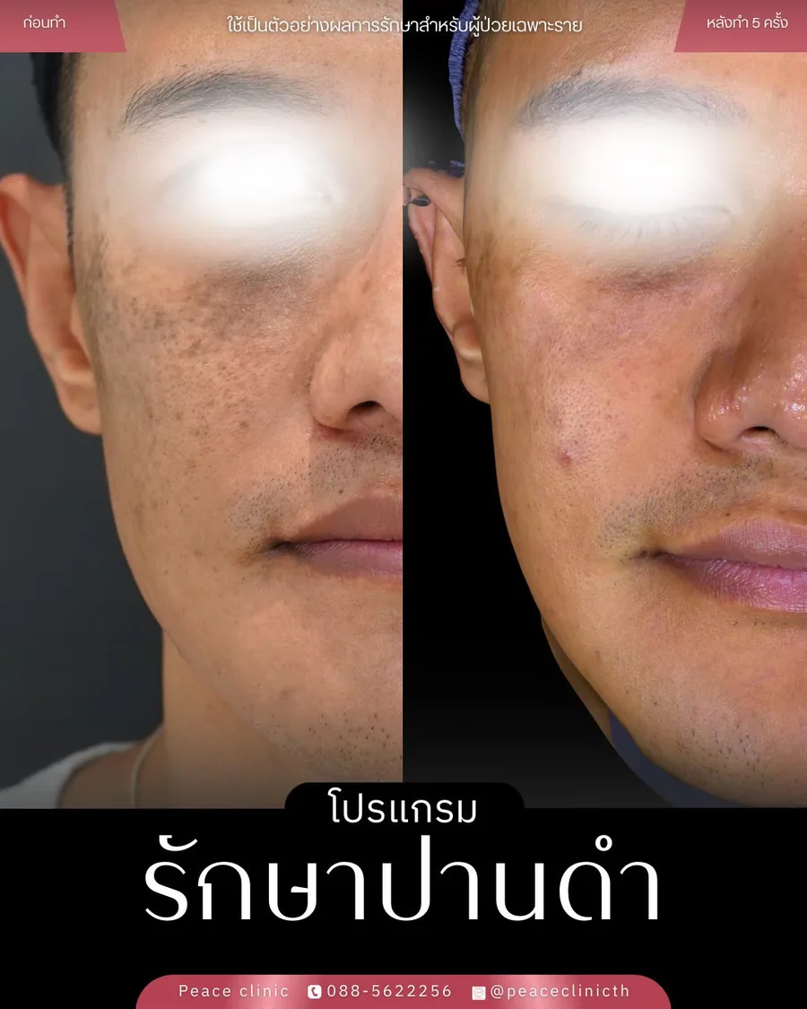 PicoSure · รักษาปานดำ — หน้าตรง