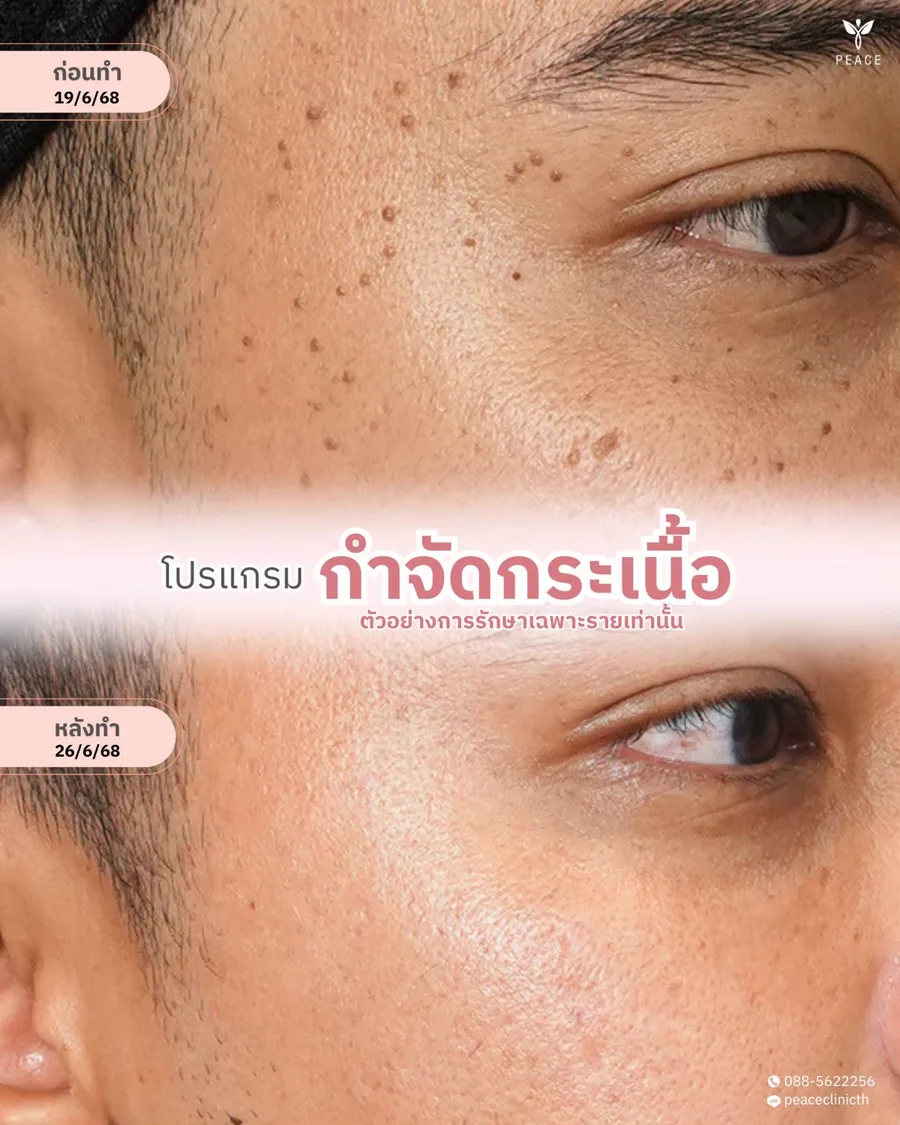 กำจัดกระเนื้อ · รอบดวงตา