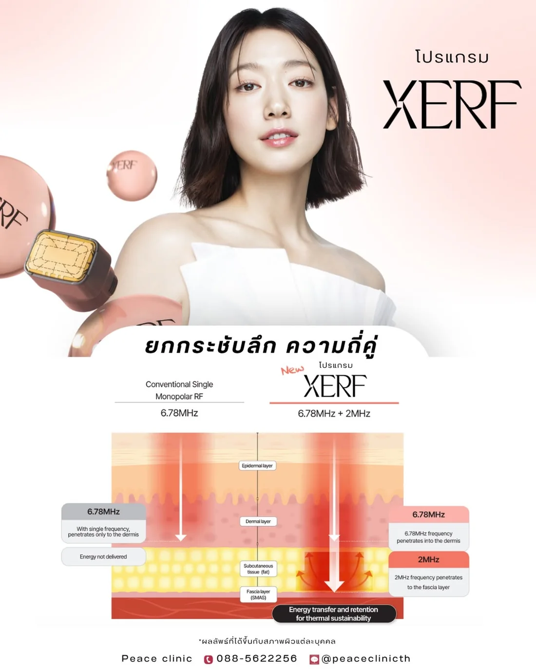 เทียบ Monopolar RF ความถี่เดียว 6.78 MHz กับ XERF ที่ใช้ 6.78 MHz ลงชั้นหนังแท้ และ 2 MHz ลงถึงชั้นฟาสเซีย SMAS